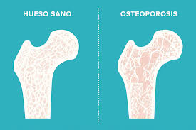 Recetas para prevenir la osteoporosis Recetas para prevenir la osteoporosis
